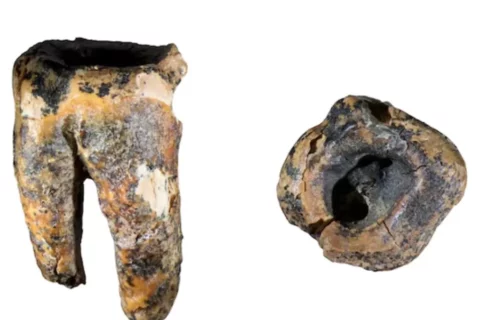 Neandertales trataban caries con piedras hace 60.000 años